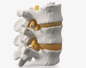 Hernias Discales