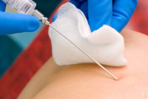 Cirugía de intervencionismo: ¿qué es y cómo evita el quirófano tradicional?