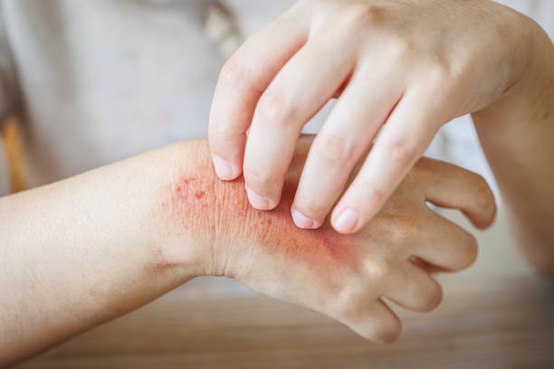 herpes zoster en mano